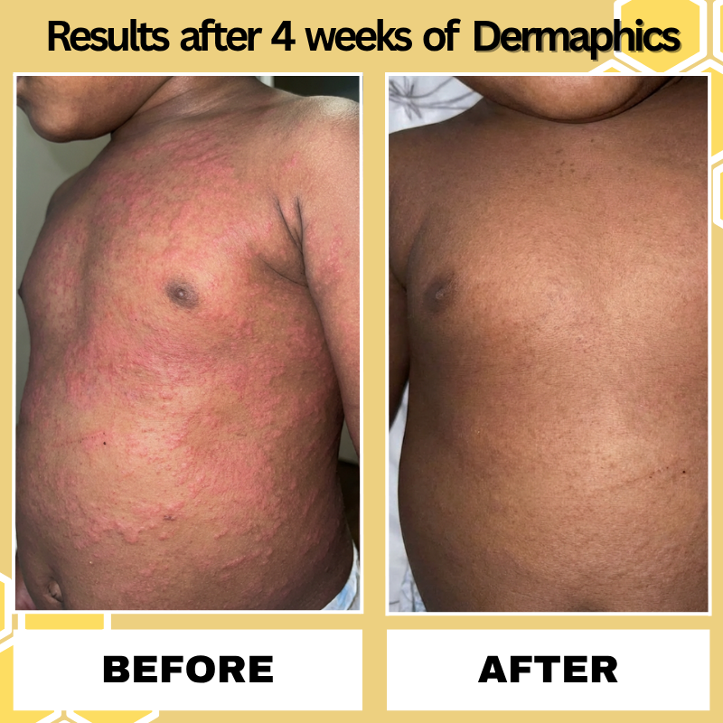 Dermaphics™ Honey Eczema Cream